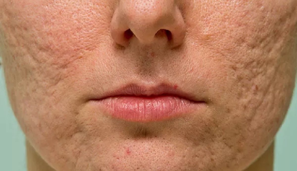 Pourquoi et comment surveiller ses grains de beauté ?