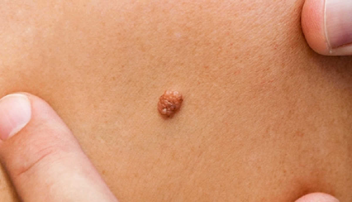 Tout savoir sur la chirurgie dermatologique du kyste sébacé