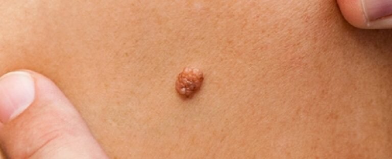 Tout savoir sur la chirurgie dermatologique du kyste sébacé - Centre de ...