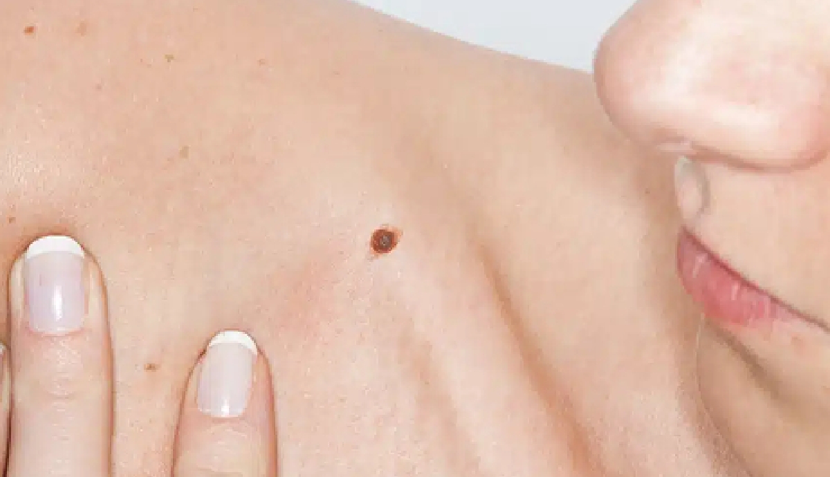 La prise en charge des chéloïdes d’oreille : solutions et traitements